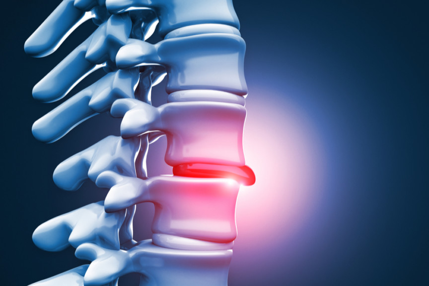 How to Treat a Herniated Disc NeuroSpine Surgical Consultants