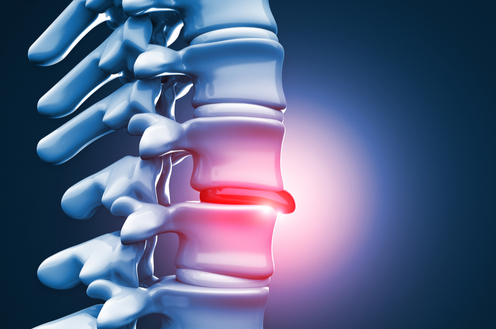 How To Treat A Herniated Disc NeuroSpine Surgical Consultants